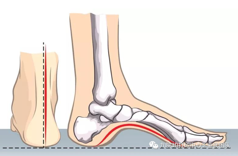 足弓的内侧纵弓呈一拱桥形状,顶端为距骨,足舟骨,内侧楔状骨,但其也有