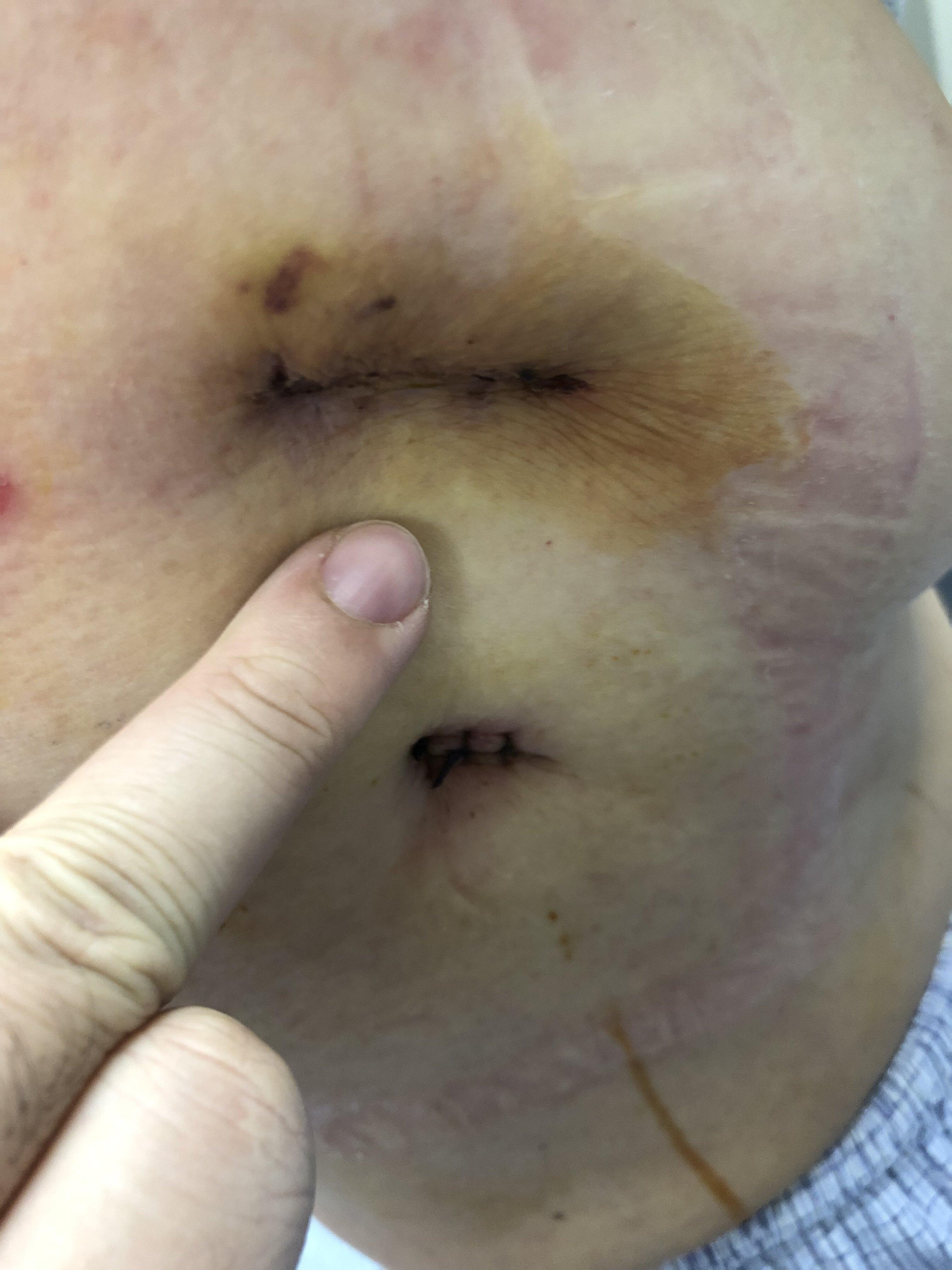 肺结节术后疤痕图图片