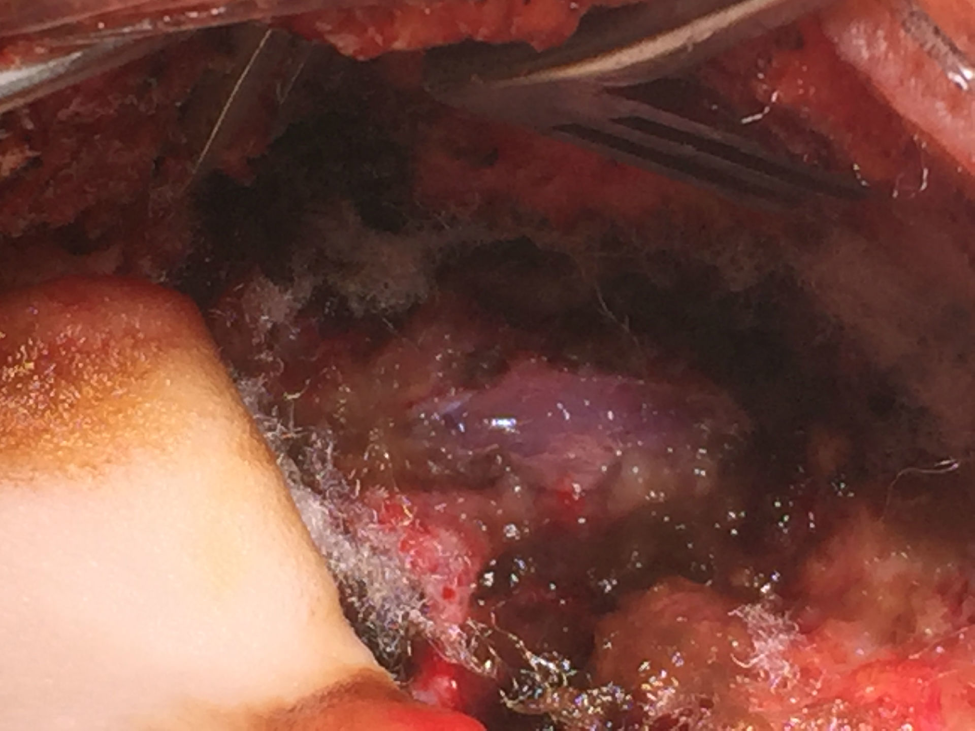 小脑扁桃体下疝一定要切除小脑扁桃体吗