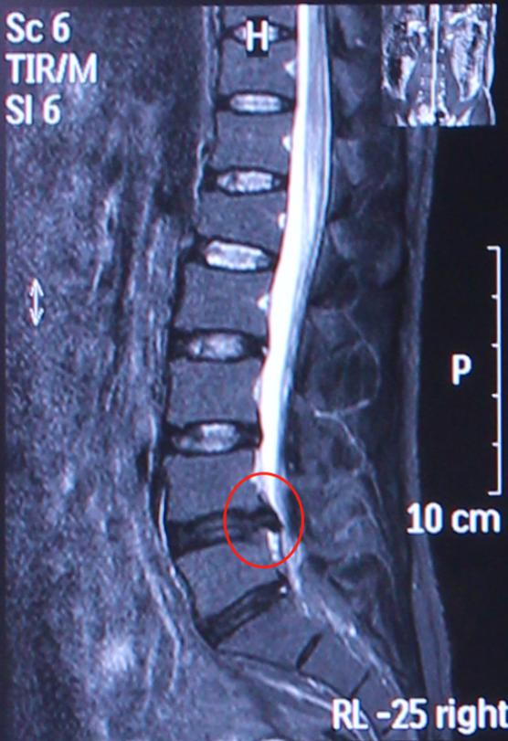 病例分享:当不敢休息的中年人遇见腰椎间盘突出症,该怎么办?