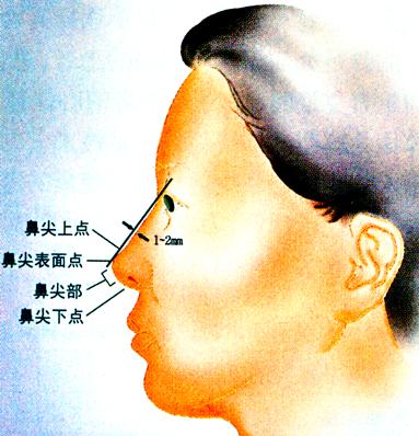 从侧面看,鼻背的起点要从上睑皱褶(supratarsal fold)处开始为恰当