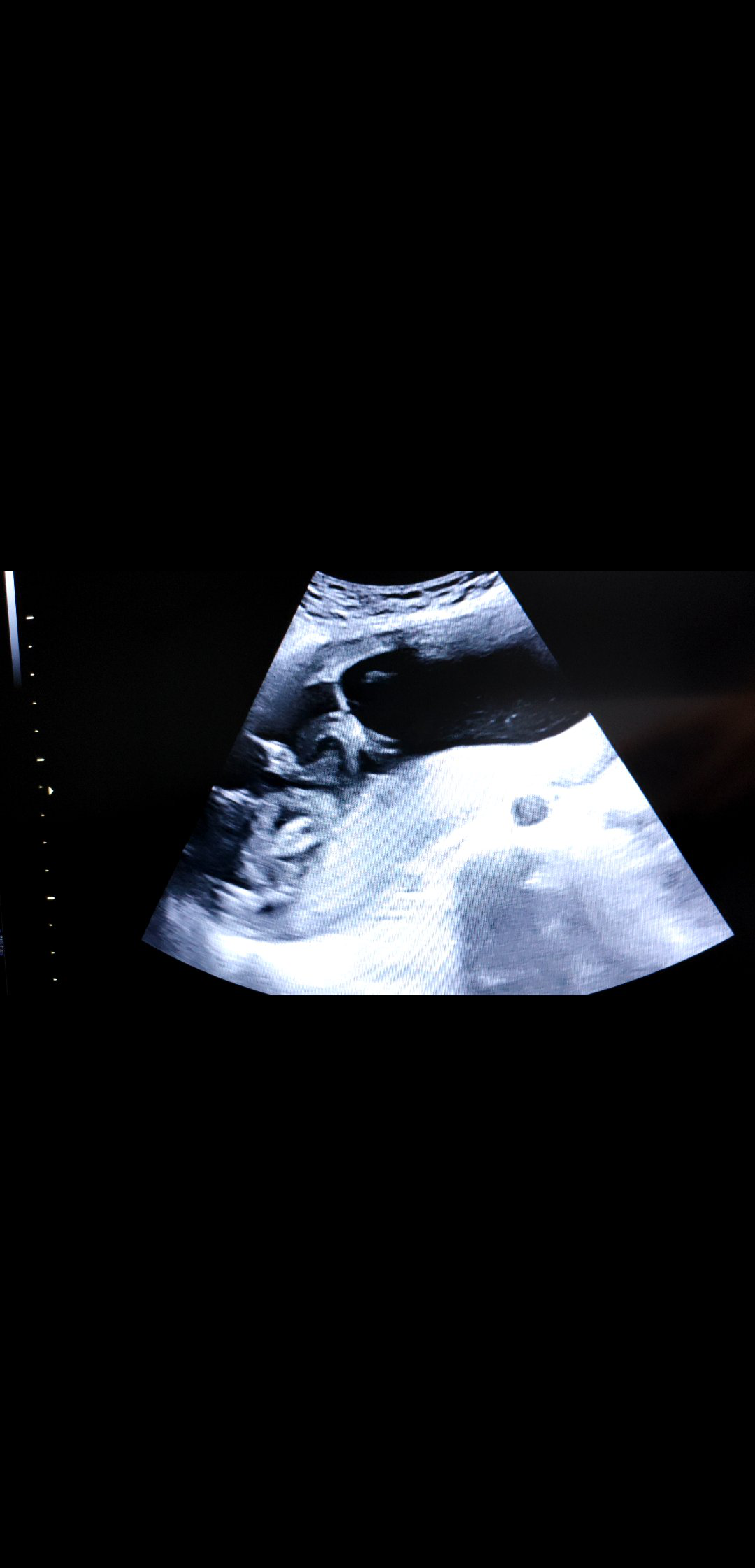 胎儿医学中心成功为一例单绒毛膜单羊膜囊双胎实施双极电凝