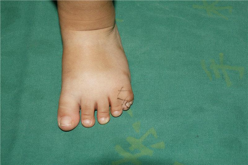 足趾残缺或畸形图片