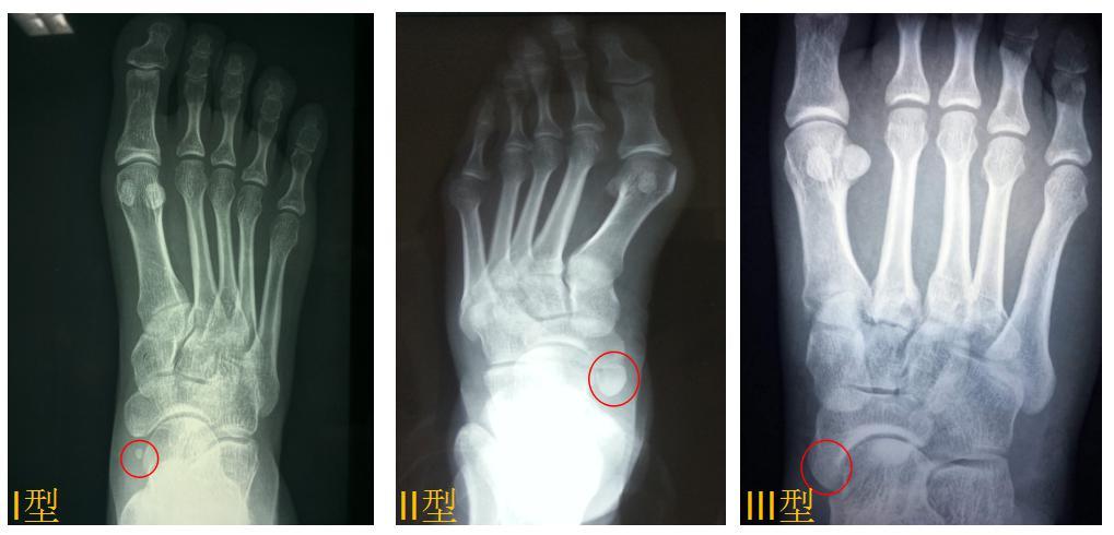 副舟骨形态各异,大小不一,位于舟骨的内后侧,既可以和胫骨形成骨性