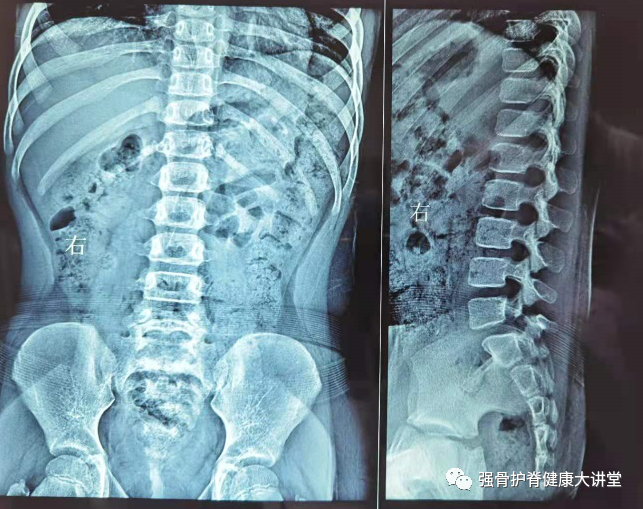 不光是外伤引起或者撒娇,也可能有先天性腰椎椎弓峡部裂和腰椎滑脱,前