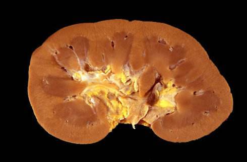 医生:小心到时肾也坏掉了-微医