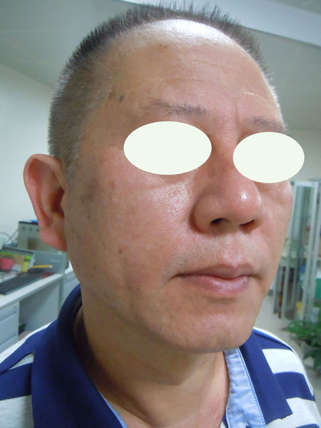 面部腮腺炎的症状图片图片