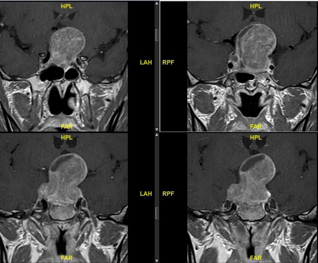 眼睛看东西越来越不清楚原来是脑垂体瘤惹的祸