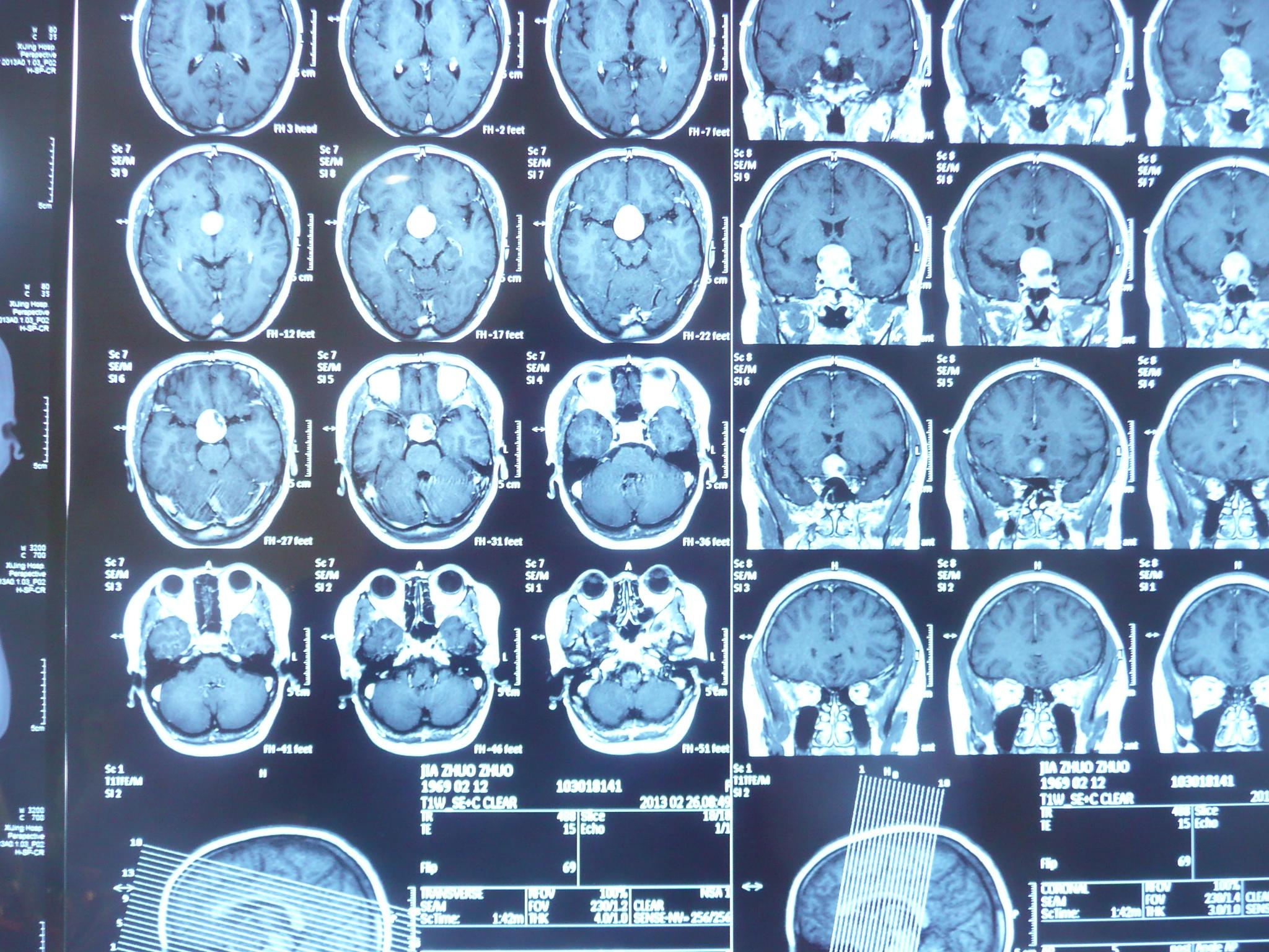贺晓生教授经前纵裂入路鞍结节脑膜瘤全切除手术