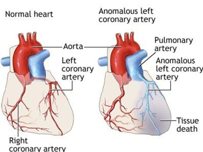 左冠状动异常连接到脉肺动脉alcapa