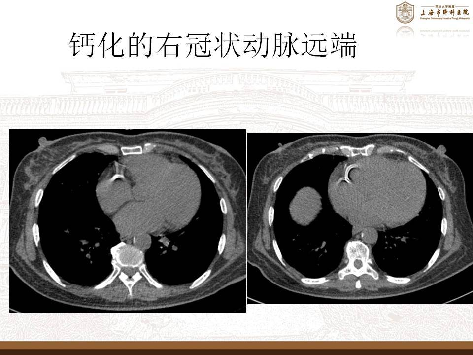 什么是冠脉钙化需要治疗吗