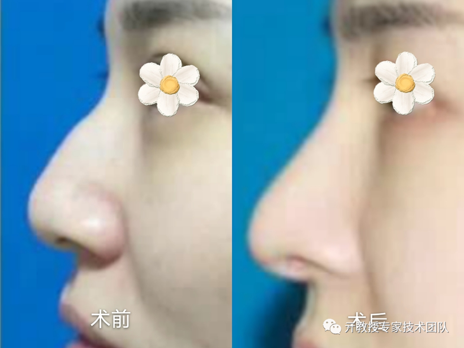 不完美鼻型之驼峰鼻