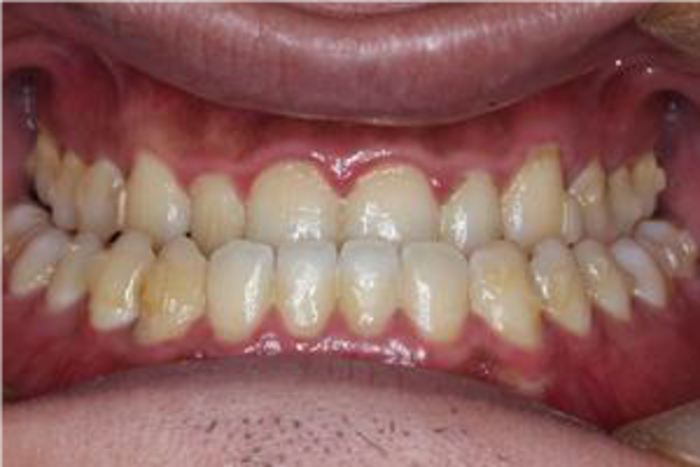 牙齿的天包地与地包天