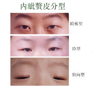 内眦赘皮是指在内眦角前方自上而下呈顺向性或自下而上呈反向性蹼状