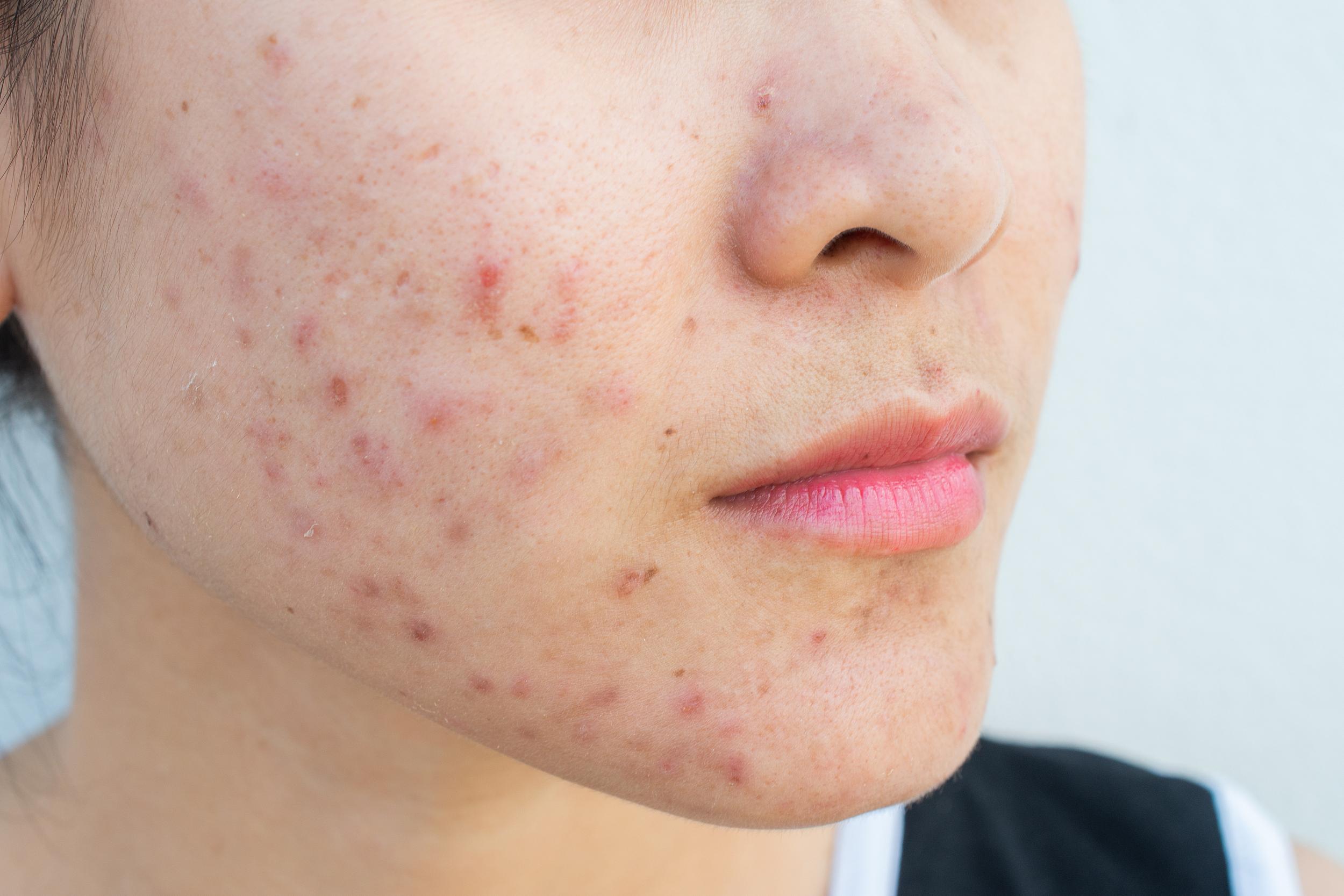 答:痘痘的产生并不是青春期的特长,三十几岁,甚至四十来岁的人都可以