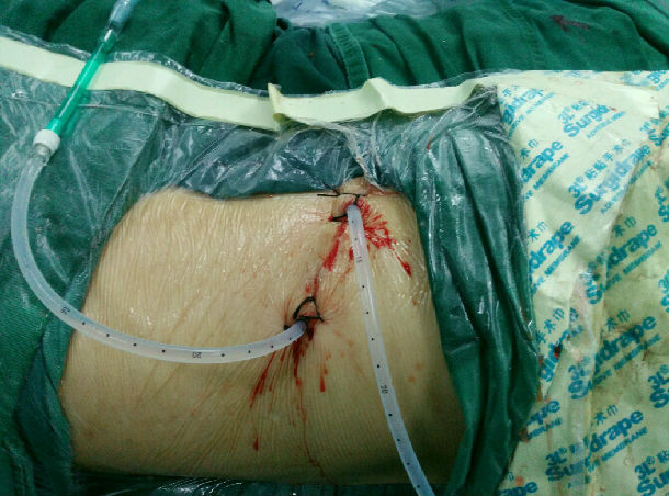 肾结石手术刀口图片图片