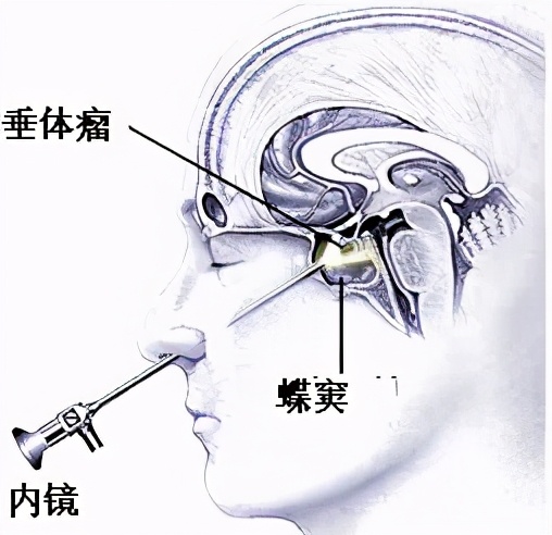 缘何眼界变窄视野模糊警惕垂体瘤