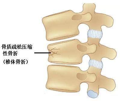 骨质疏松性椎体压缩性骨折(ovcf)是指由骨质疏松症导致椎体骨密度和骨