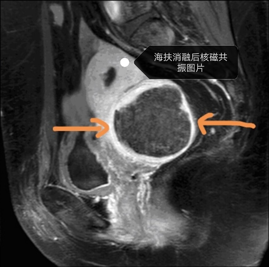 病例1 子宫肌壁间肌瘤-妇产超声读片-医学