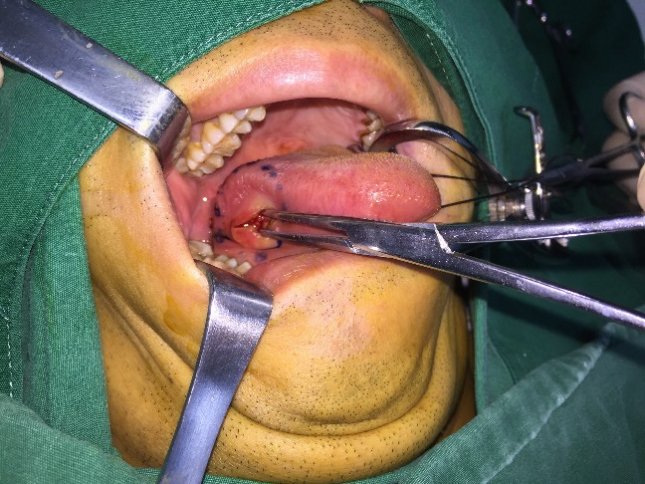 舌头肿瘤舌头莫名长肿物疑肿瘤检查才知竟是鱼刺插入舌头