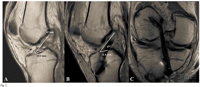 成人前交叉韧带初次撕裂的手术治疗