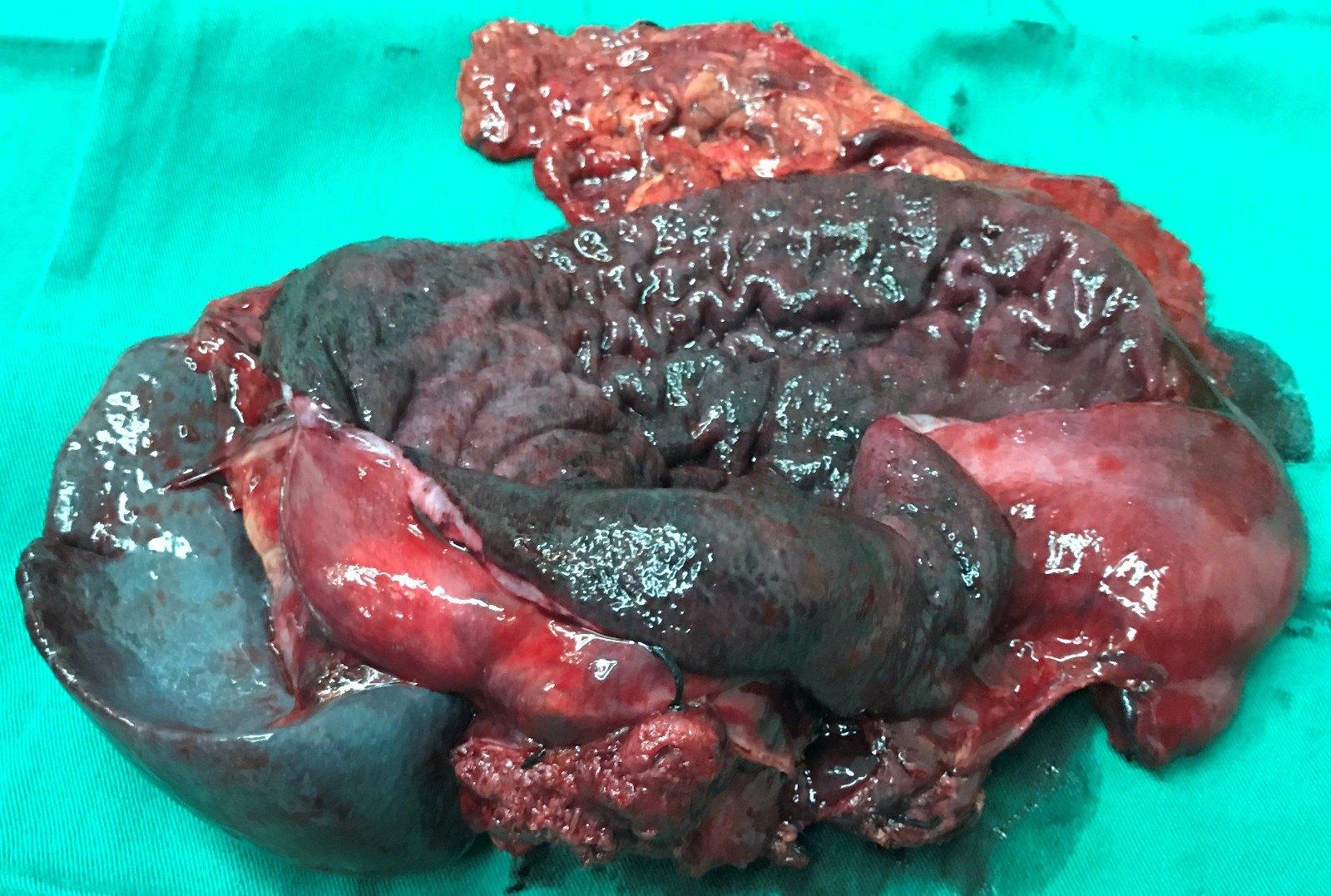 胃癌症真实肿瘤图片图片