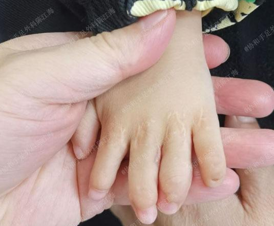 孩子波兰综合征大小手并指分指后还会长大吗