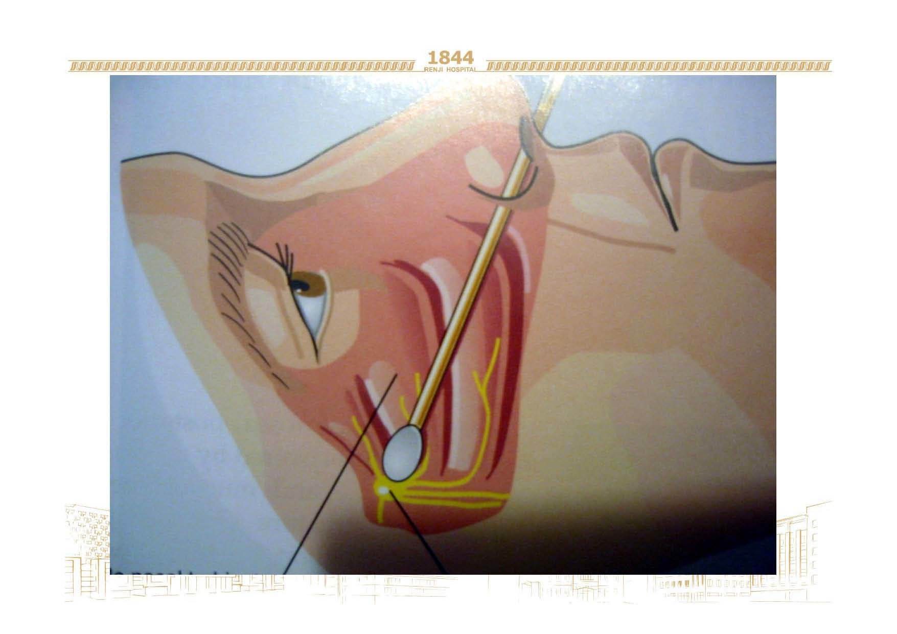蝶腭神经节针刺术图片