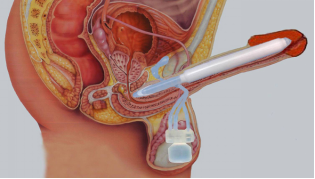 原创全面了解阴茎支撑体假体手术之四问题以及原因分析