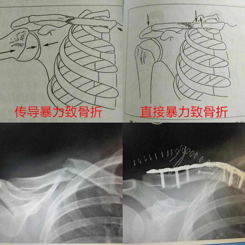 锁骨骨折术后康复 健康号 微医