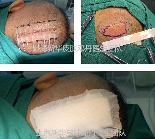 皮脂腺痣手术切除步骤图片