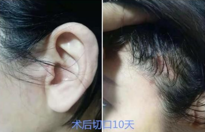 做面部拉皮手术真的不会留疤吗恢复期要注意什么