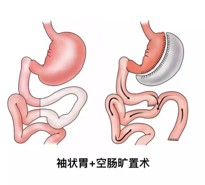 袖状胃切除术术加空肠旷置术的减肥原理是什么