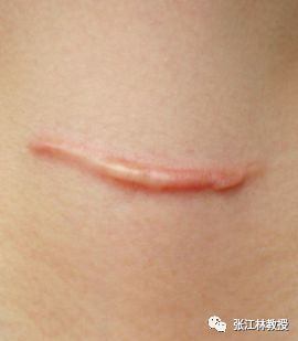 增生性瘢痕瘢痕疙瘩治疗全掌控