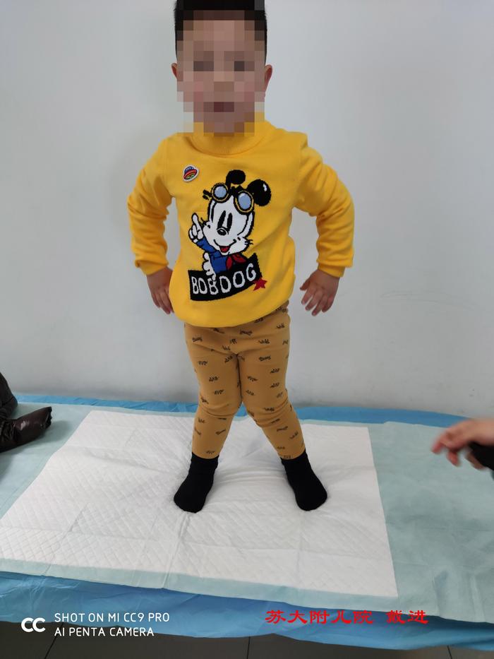 典型病例严重膝外翻畸形的微创手术治疗