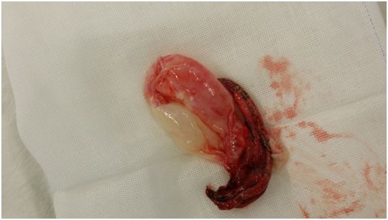 早期手术干预是必要的,因为这类患者复发率极高,外科手术切除肺大泡