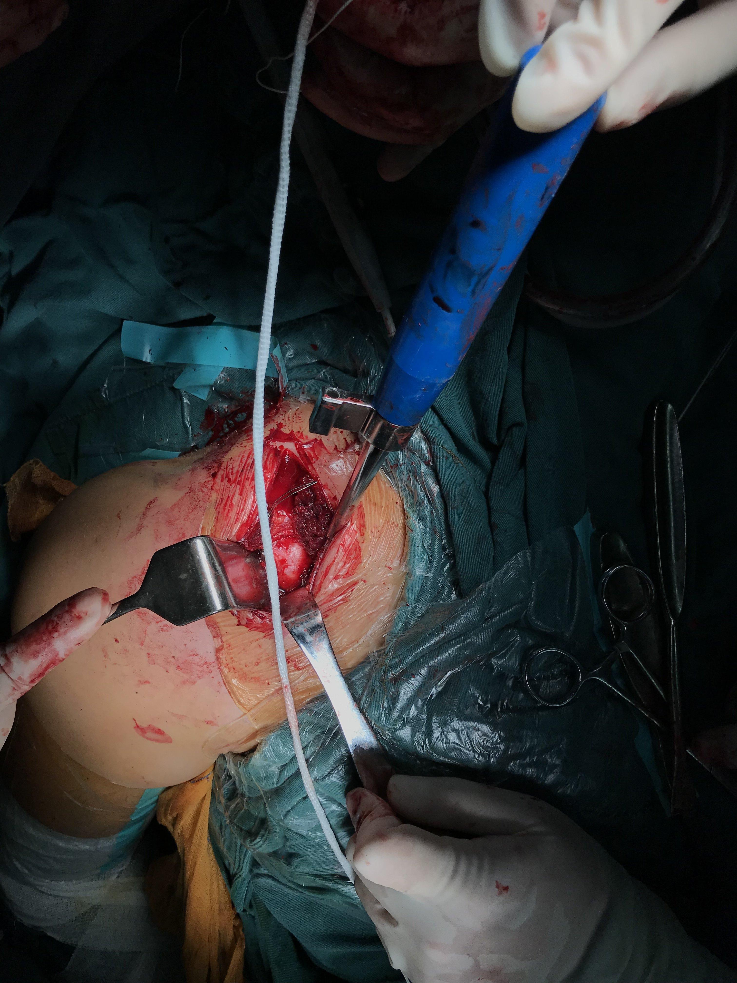 胸锁关节脱位手术步骤图片