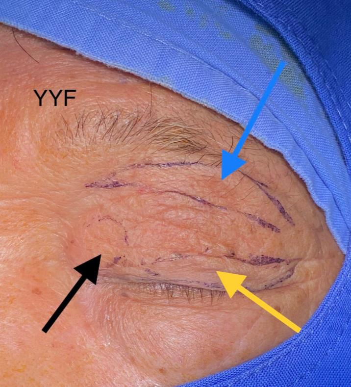 双眼睑皮肤松弛的手术矫正解决倒睫外观以及视线遮挡