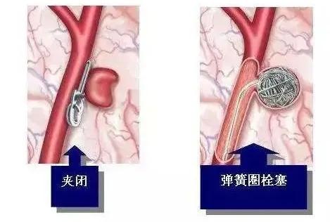 颅内动脉瘤示意图图片