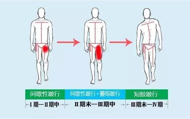 5,股骨头缺血坏死