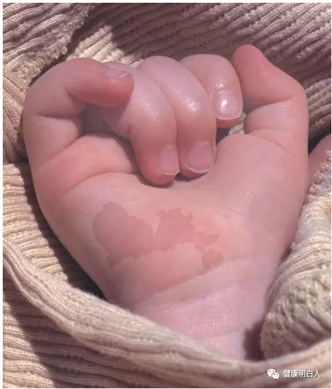 姚明7岁女儿心形胎记遭热议北京日报专访张斌博士