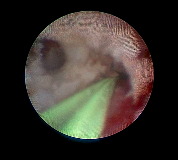 输尿管镜下钬激光碎石术的注意事项