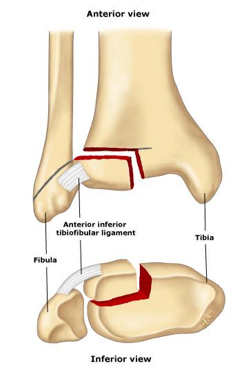 所以当外侧已经闭合,内侧还是软骨连接时,内侧往往容易发生骺离骨折.