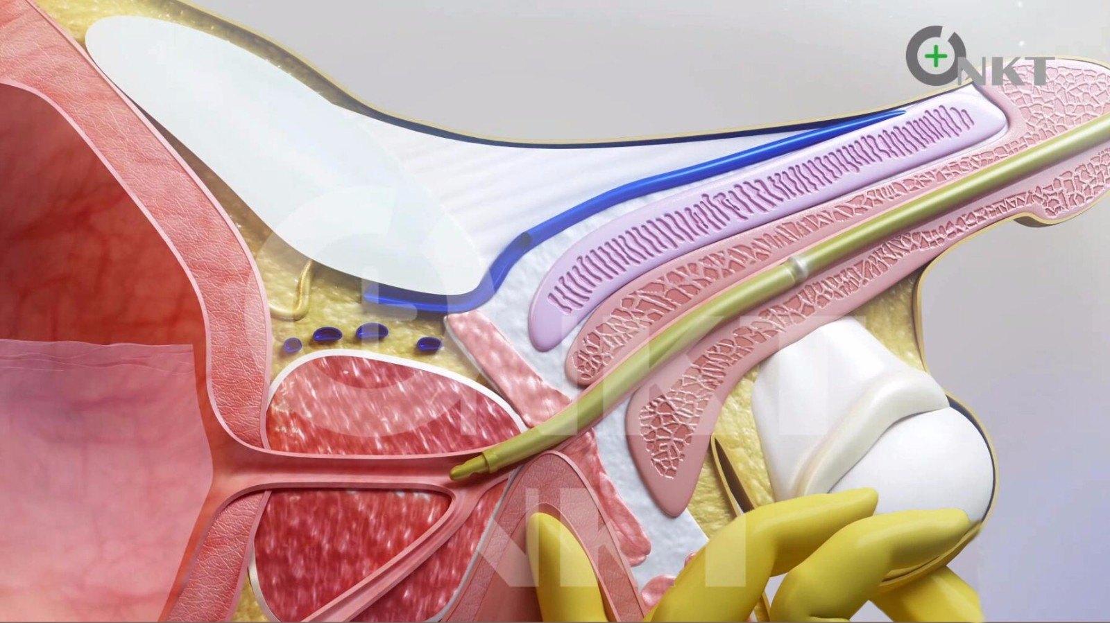 小小水囊显神威前列腺增生患者的福音