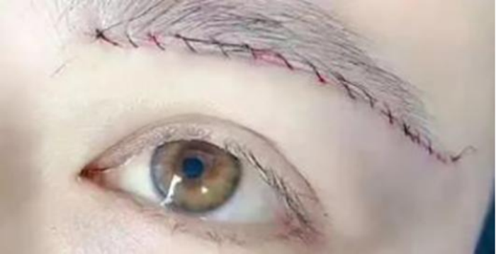 提眉或切眉术后可以不留疤吗