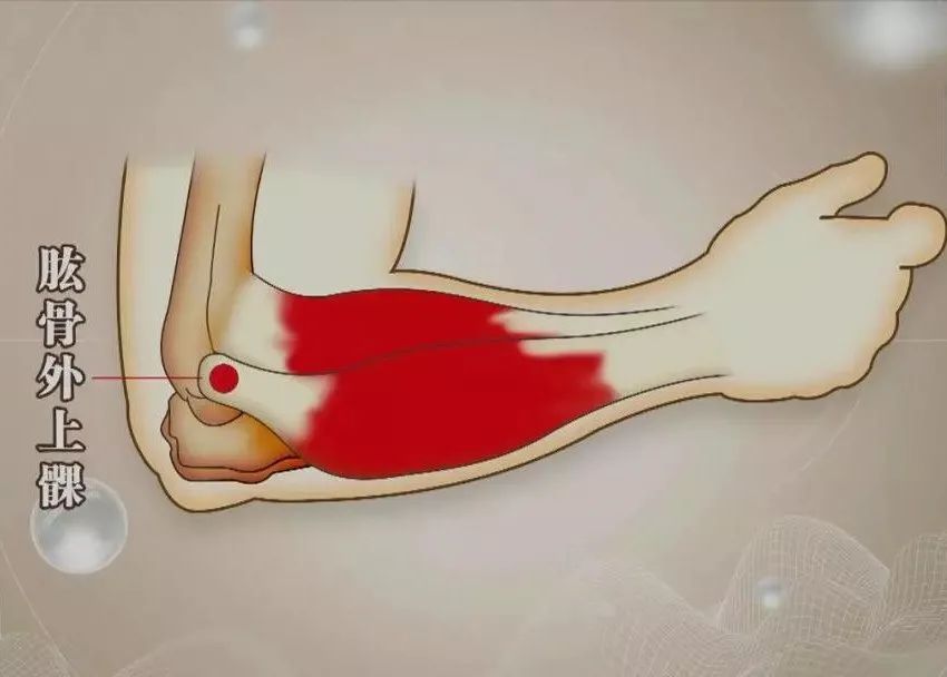 详细了解网球肘