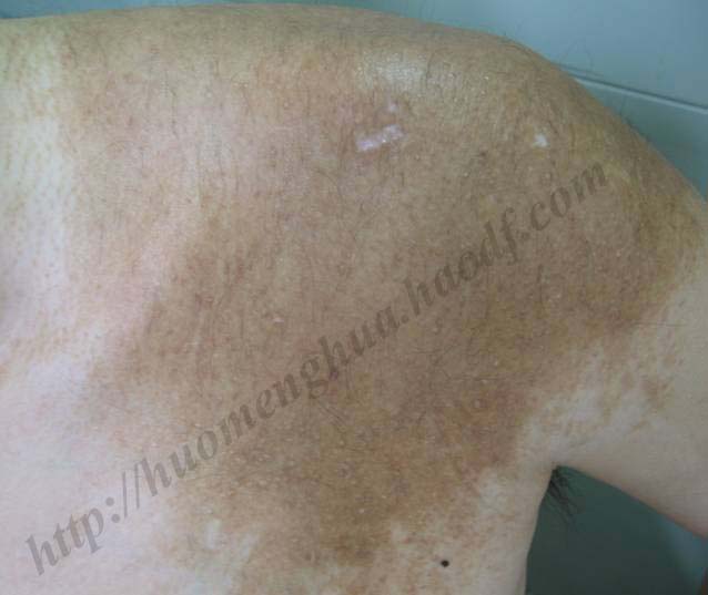 becker痣多毛_霍孟华医生文章_中国医学科学院整形外科医院-微医