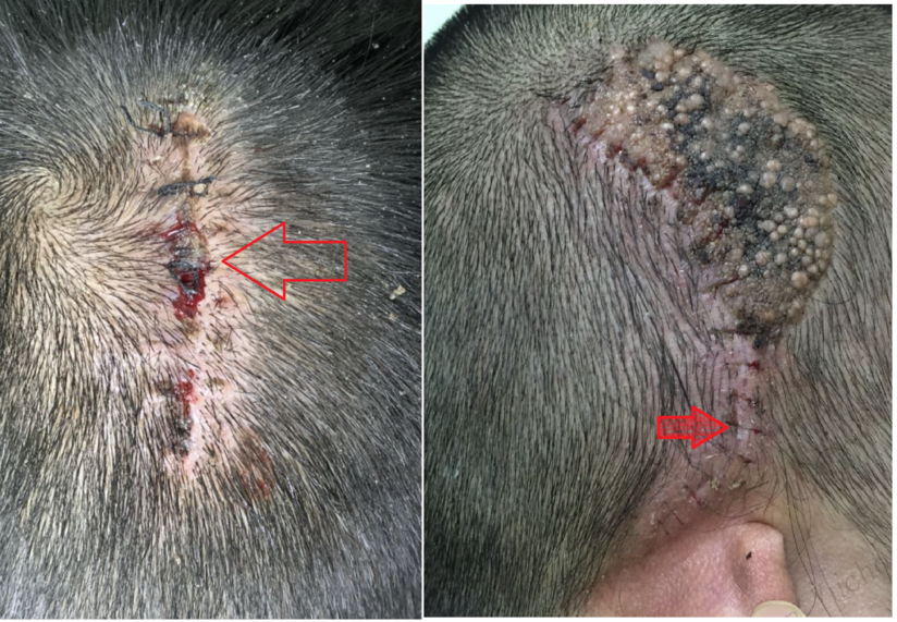 皮肤手术后注意事项 再谈如何减轻瘢痕 健康号 微医