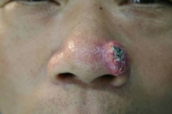 鼻翼鳞状细胞癌的手术切除与重建图