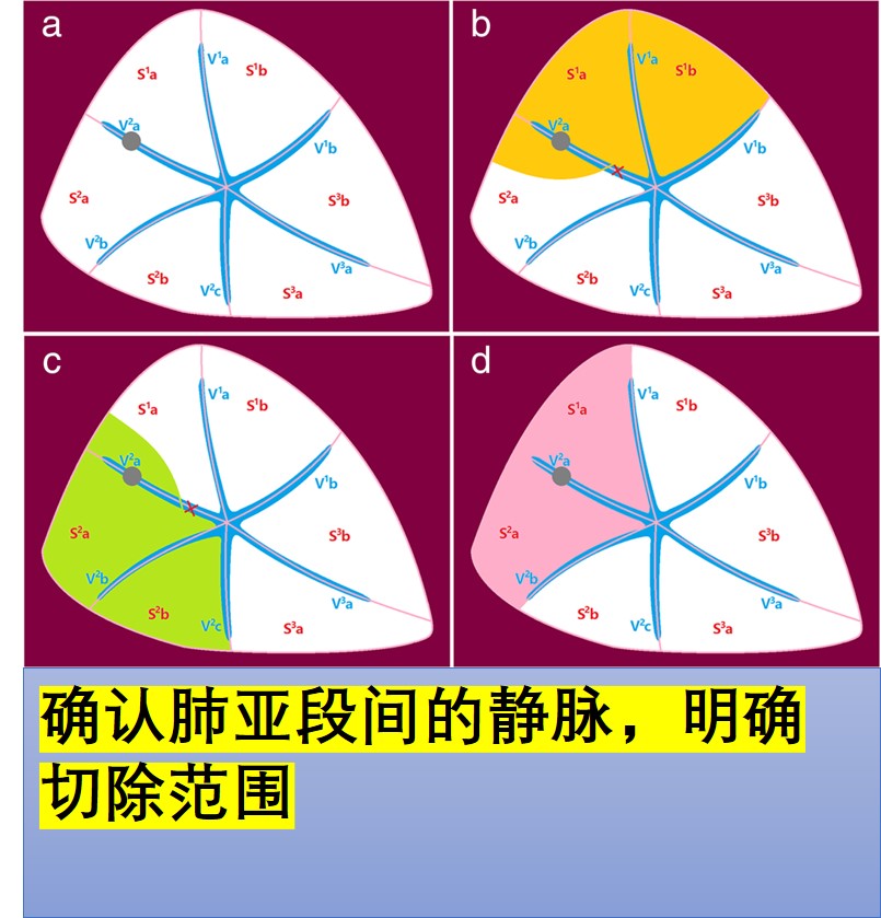 肺段和亚段图图片